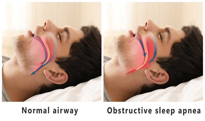 Obstructive Sleep Apnea Example