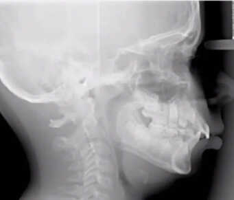 Sleep Apnea In Children Example