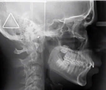 Sleep Apnea In Children Example